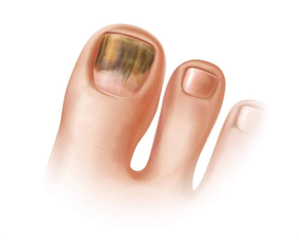 Ayak Tırnak Mantarı Tedavisi 